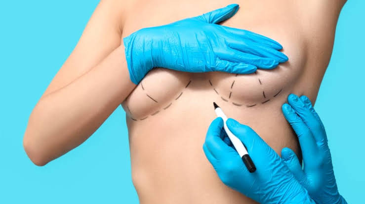 Como aumenta tu autoestima el aumento de pechos con mamoplastia
